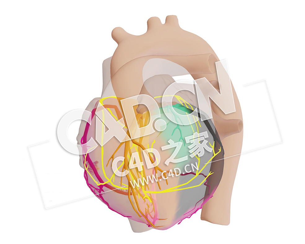C4D心脏心肌梗死近端回旋动脉梗塞模型 Proximaal Circumflex Arterie (CX) Infarct - C4D之家 - 04.jpg