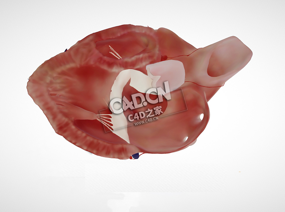 房室间隔缺损C4D模型下载 Atrioventricular septal defect, PSLAX