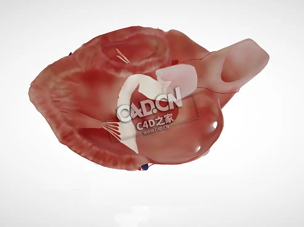 房室间隔缺损C4D模型下载 Atrioventricular septal defect, PSLAX