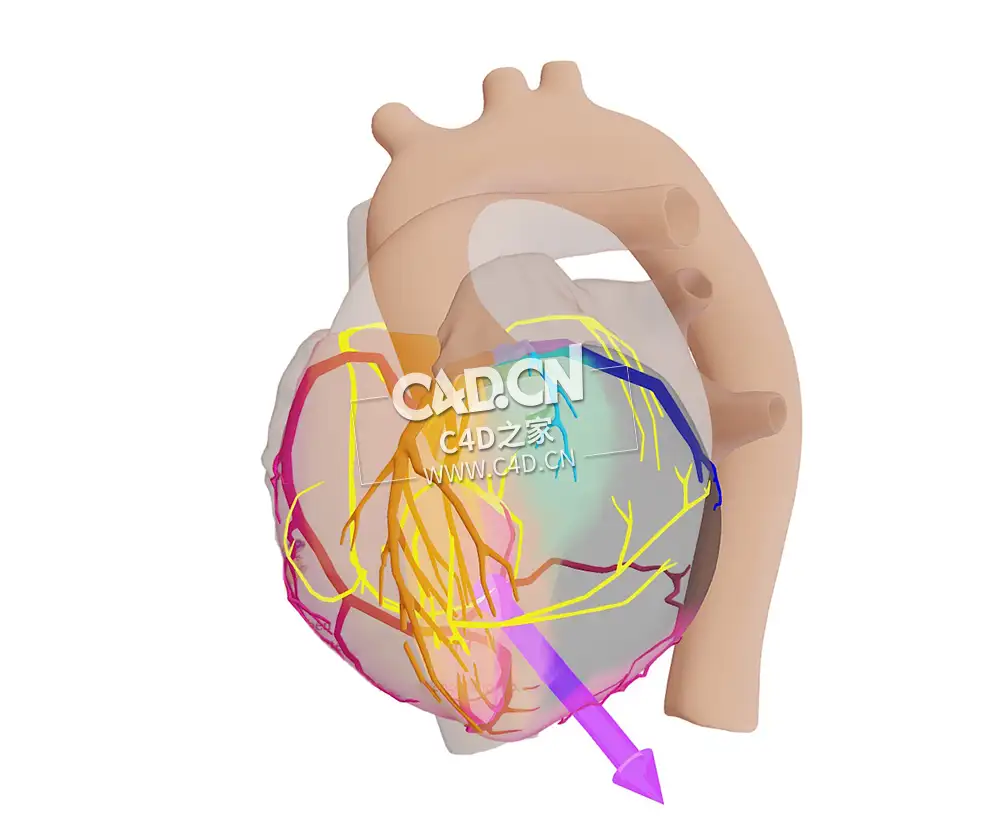 心脏CX梗死C4D模型 CX Infarct met Vector