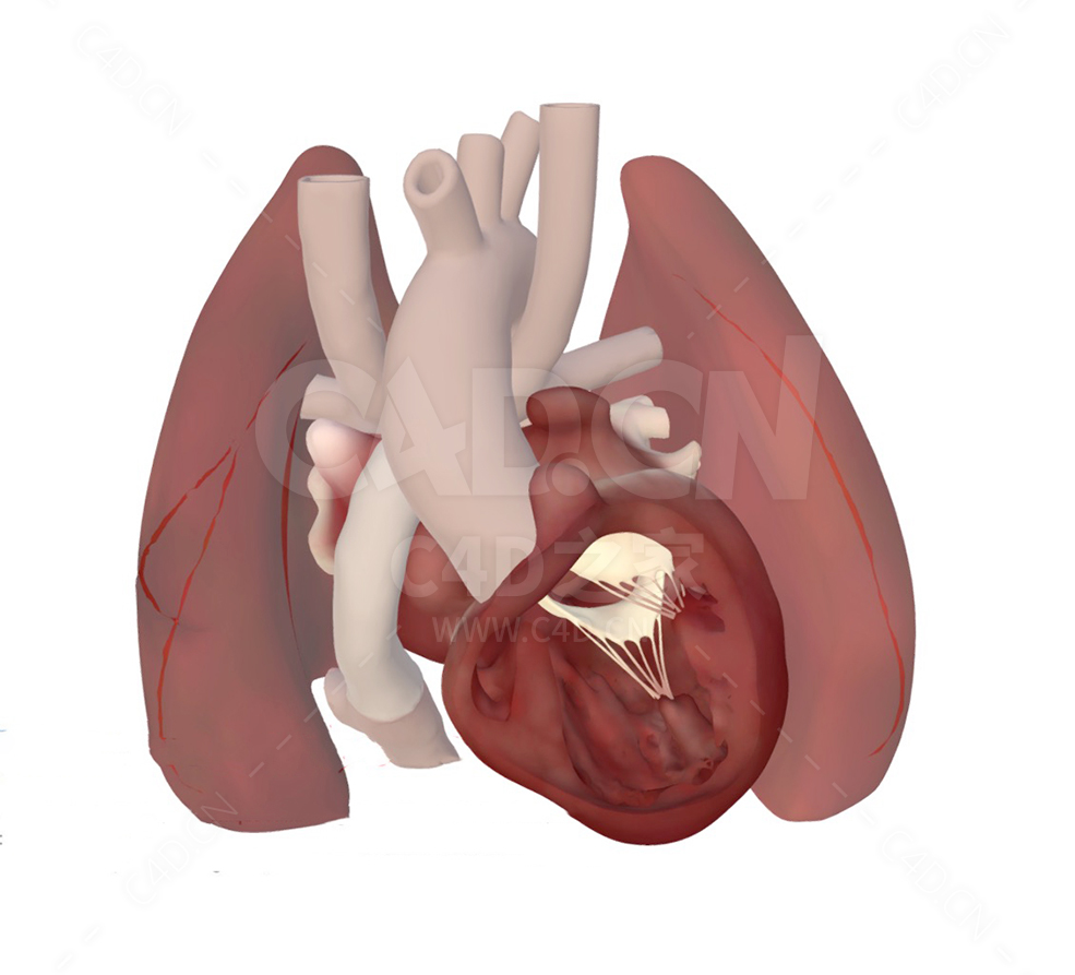 心脏模型 Heart after Bilateral Fontan Procedure