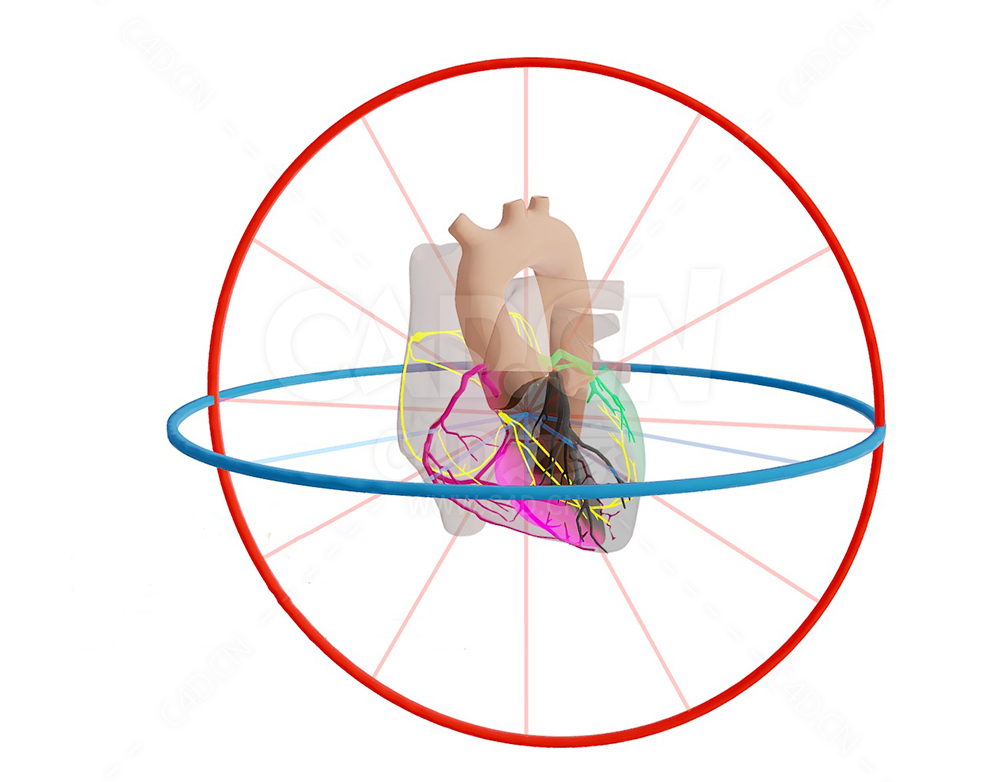 心脏 Mid LAD Infarct met Afleidingen-1