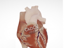 人体心脏完全型房室间隔缺损C4D模型下载 Atrioventricular septal defect