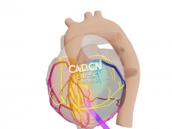 心脏CX梗死C4D模型 CX Infarct met Vector