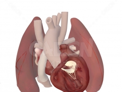 心脏模型 Heart after Bilateral Fontan Procedure