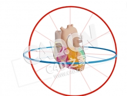 C4D心脏近端梗死左主导分心模型 Proximaal CX Infarct Links Dominant +Afleidingen