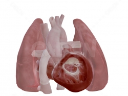心脏 Heart after Fontan Procedure