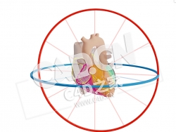 C4D心脏近端梗塞伴分心模型 Proximaal CX Infarct met Afleidingen