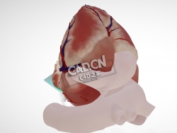 房室间隔缺损四腔视图C4D模型下载 Atrioventricular septal defect, 4 chamber view