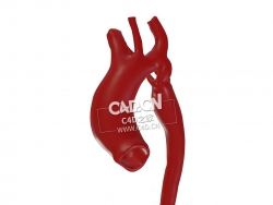 动脉管主动脉狭窄C4D模型 Coarctation of the aorta