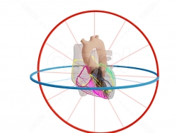 心脏 Mid LAD Infarct met Afleidingen-1